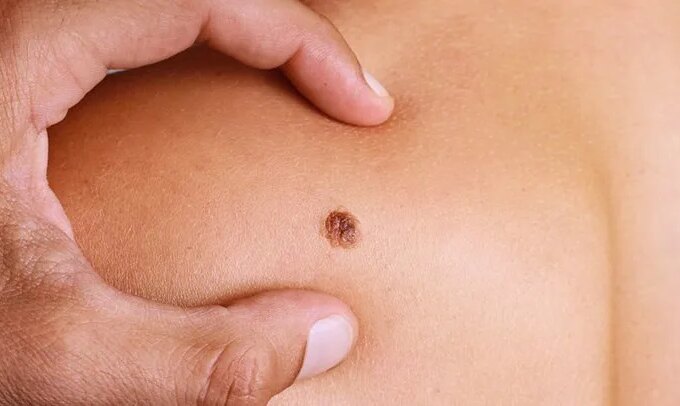 Metastatic Melanoma: Symptoms, Stages, Treatment